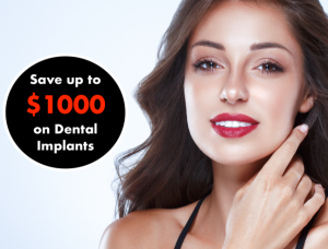 Dental Implants