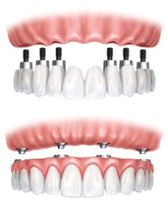 Dental Implants