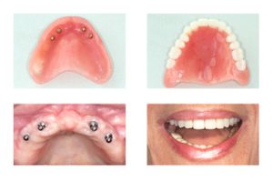 Dental Implants